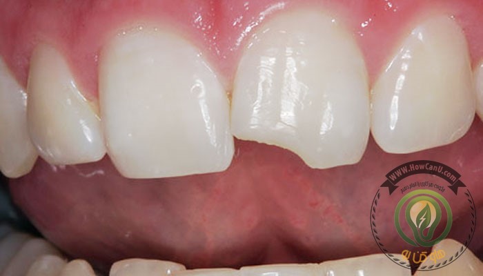 broken-tooth-dentist-san-diego